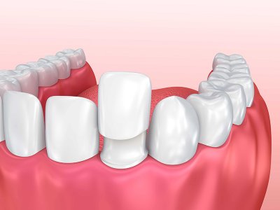 Porselen Diş Kaplamaları (Kron)