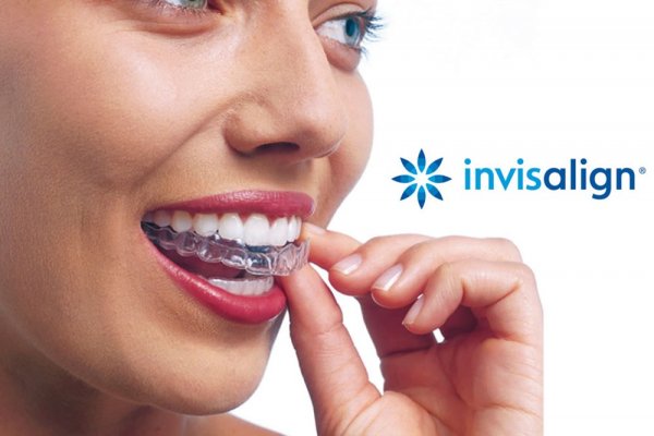 Invisalin - geleneksel diş telleri yerine şeffaf plakları seçmek için 6 neden