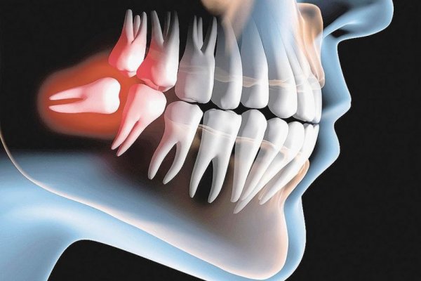 Yirmilik Dişlerin Çıkarılmasıyla İlgili Sık Sorulan Sorular
