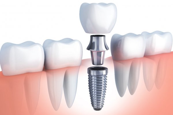 Diş implantların bir ömrü var mı?