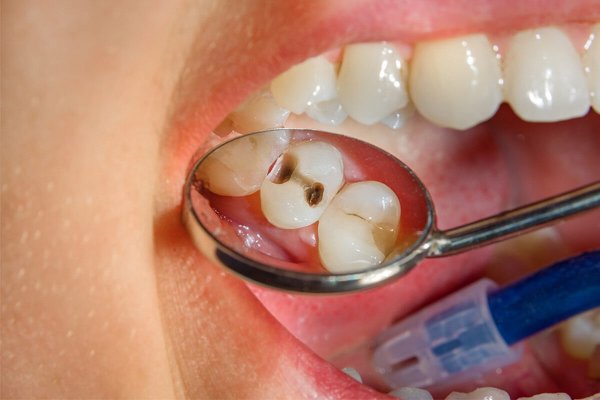 Bir diş dolgusu ne zaman değiştirilmelidir?