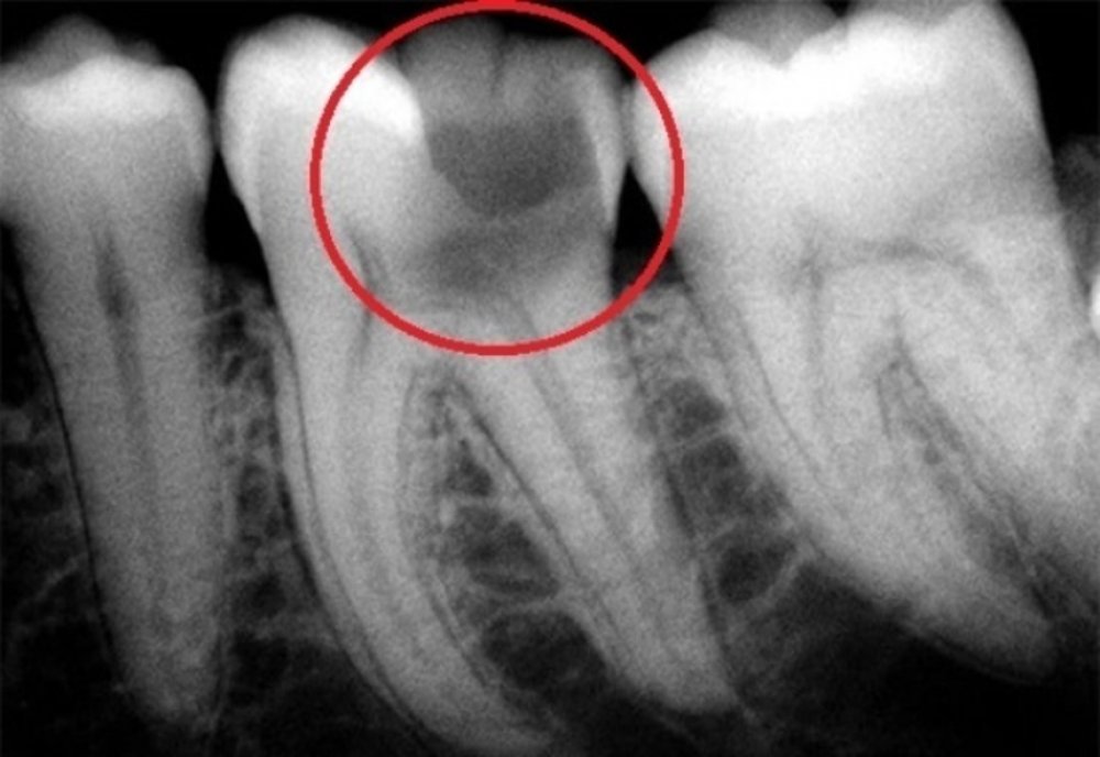 Tedavi Edilmeyen Diş Çürükleri Neye Yol Açar?